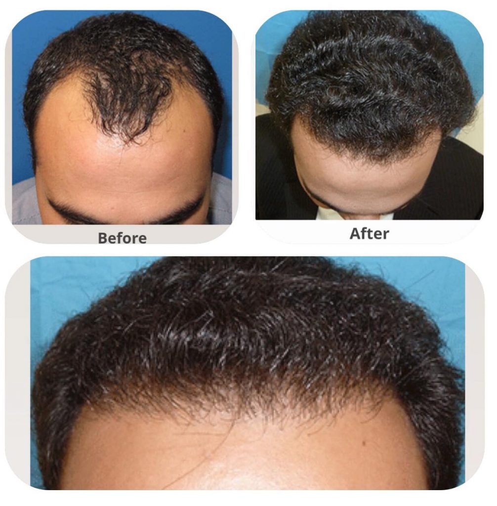 5 Best PRP Hair Treatment in Dubai: PRP Clinics with Prices - UAE INSURE
