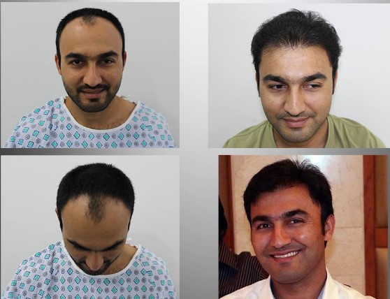 Best Hair Transplant Clinics in Dubai